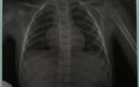 案例报道：宏基因组病原微生物检测助力肺部病毒感染的诊疗